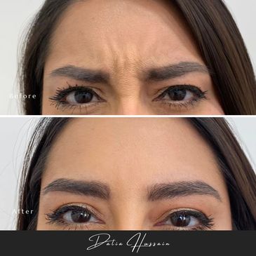 Botox 3 Areas Kingston | Botox 3 Areas Kingston Upon Thames | Price £184