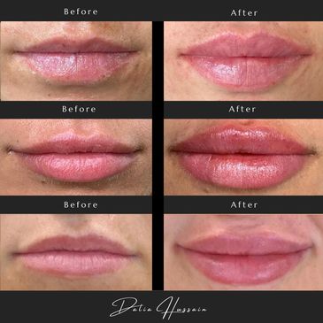 Lip Filler Before And After | Lip Filler Kingston | Lip Filler Near Me Kingston | Lip Filler Results