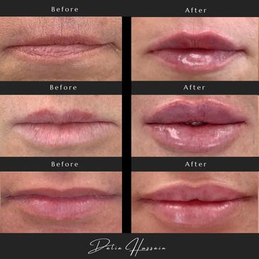 Lip Fillers Before And After | Lip Filler Kingston | Lip Filler Near Me Kingston | Lip Filler Result