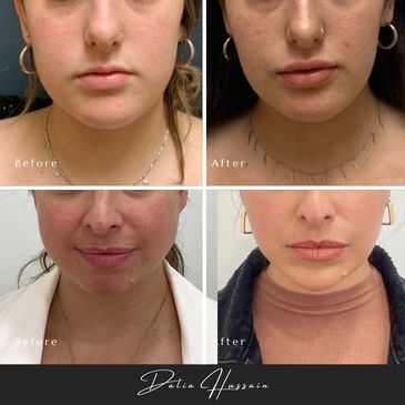 Masseter Botox, Jaw Botox Kingston, Masseter Botox Before And After
