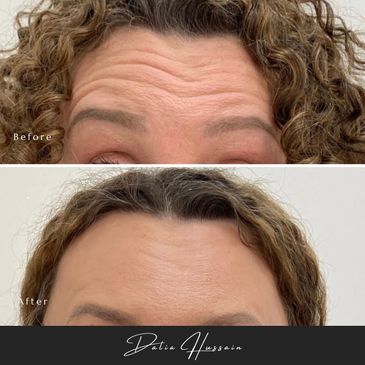 Botox 3 Areas Kingston | Botox 3 Areas Kingston Upon Thames | Price £184