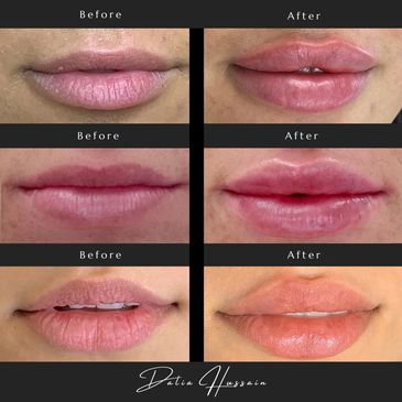 Lip Filler | Lip Filler Kingston | Lip Filler Near Me Kingston | Lip Fillers Results