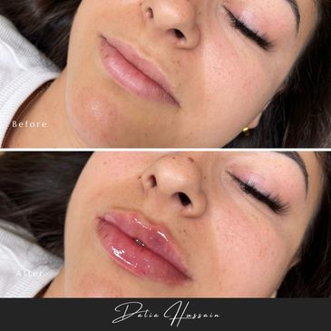 Russian Lip Filler, Russian Lip Fillers, Russian Lip Filler Kingston, Russian Lip Filler technique