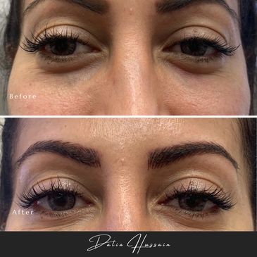 Jelly Roll Botox Kingston | Jelly Roll Botox treatment | Botox injections Kingston