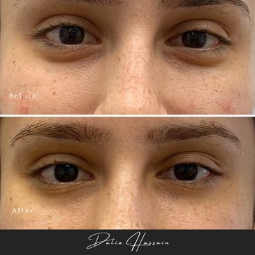 Jelly Roll Botox Kingston | Jelly Roll Botox treatment | Botox injections Kingston
