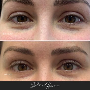 Jelly Roll Botox Kingston | Jelly Roll Botox treatment | Botox injections Kingston