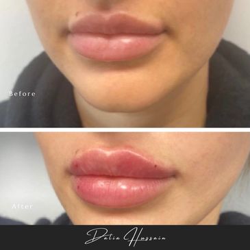 Russian Lip Filler, Russian Lip Fillers, Russian Lip Filler Kingston, Russian Lip Filler technique