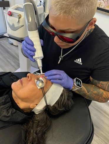 Laser Tattoo Removal