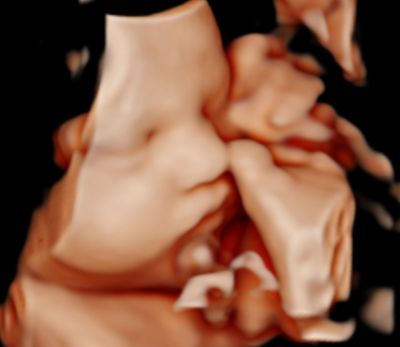 3D ultrasound image of a fetus inside the womb.