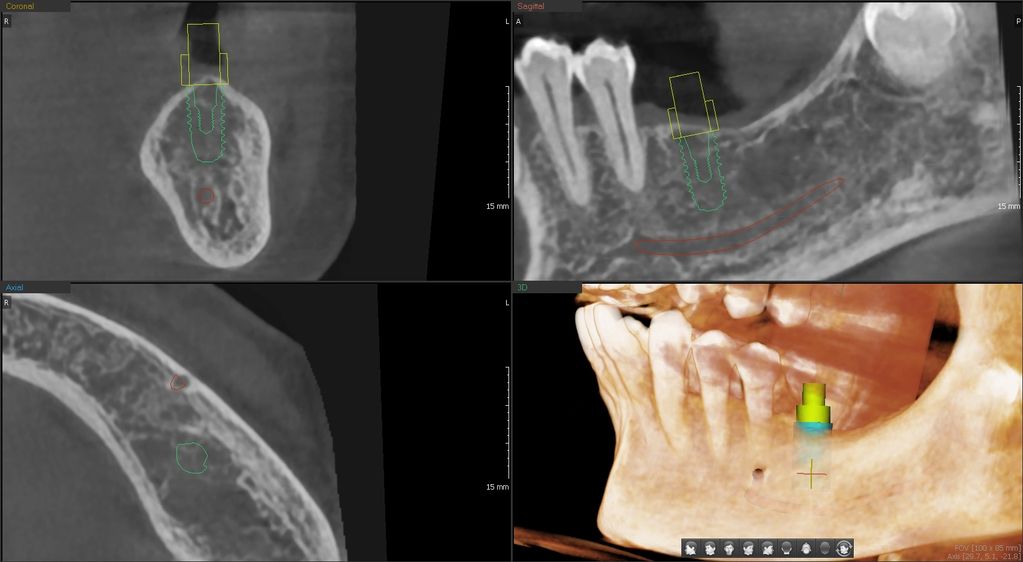 CBCT, cone beam computed tomography, implant planning