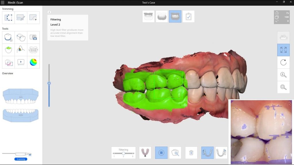 Intraoral scanner, Medit i500, digital impression