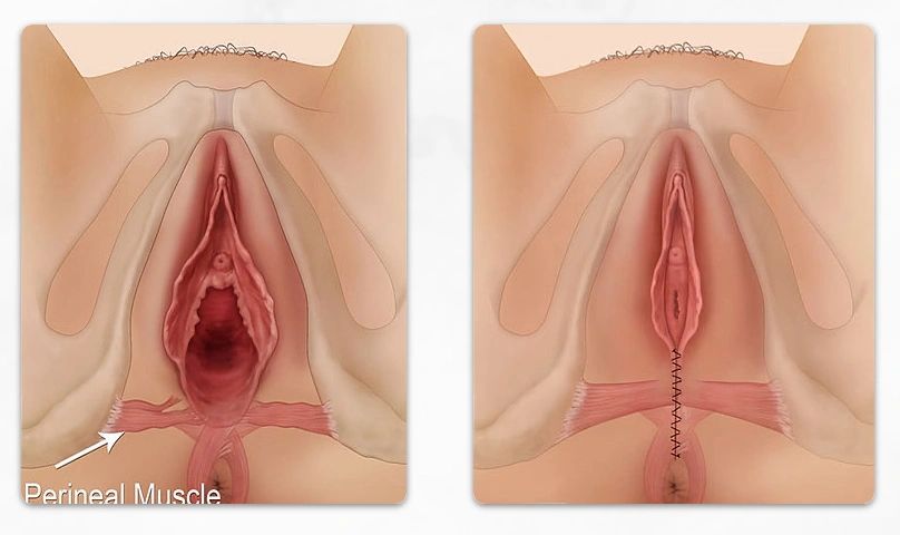 Vaginoplasty surgery