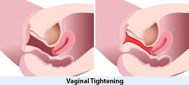 Vaginoplasty (vaginal tightening)