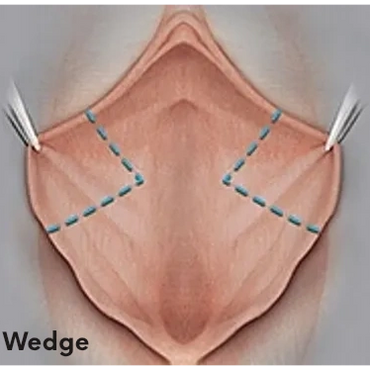 تجميل و تصغير الشفرتين الصغيرتين