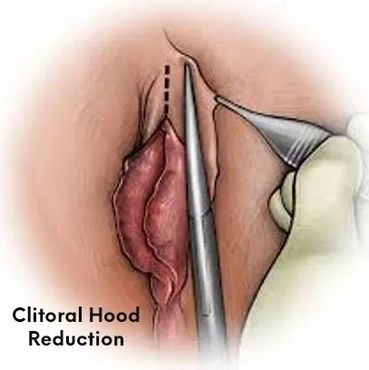 Clitoral Hood Reduction (CHR)