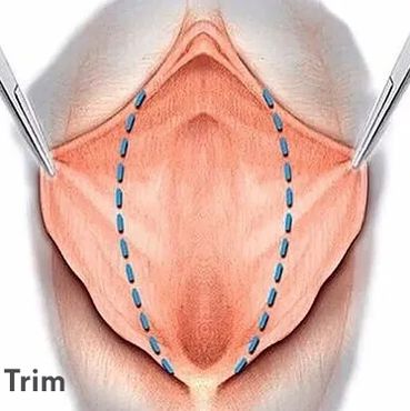 تجميل و تصغير الشفرتين الصغيرتين