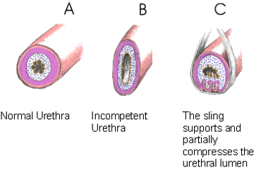 Female Urinary Incontinence treatment