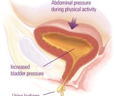stress urinary incontinence