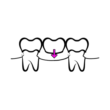 Dental Bridges Atlas Smiles Dental