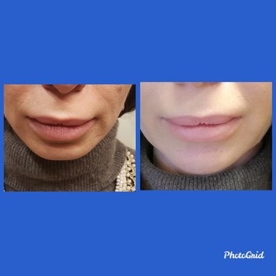 Before After Chin Filler