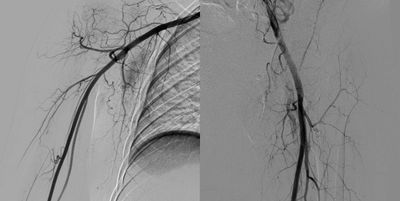 Angiografía miembro superior e inferior angioplastía. Radiología Intervencionista