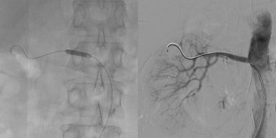 Angioplastia renal estenosis renal stent renal. Radiología Intervencionista
