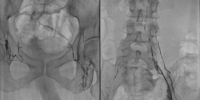 Linfangiografía cisterna del quilo quilotorax ascitis quilosa. Radiología Intervencionista
