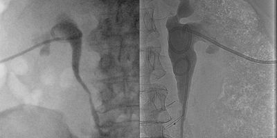 Nefrostomía percutánea catéter doble J anterógrado dilatación de sistema colector estenosis ureteral
