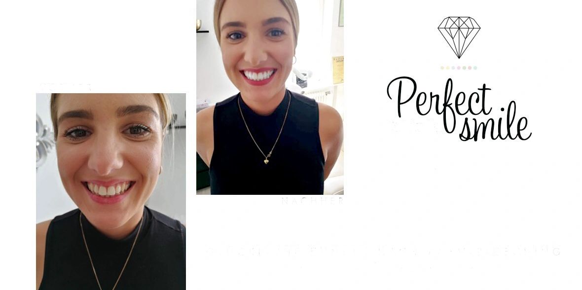 Results teeth whitening woman