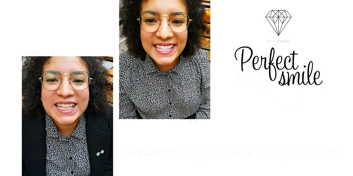 Result teeth bleaching woman