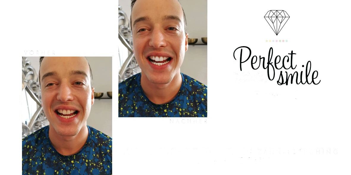 Results teeth whitening man