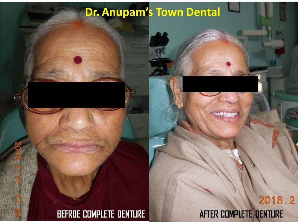 A female Patient without any teeth complained of inability to chew food and unpleasing appearance.