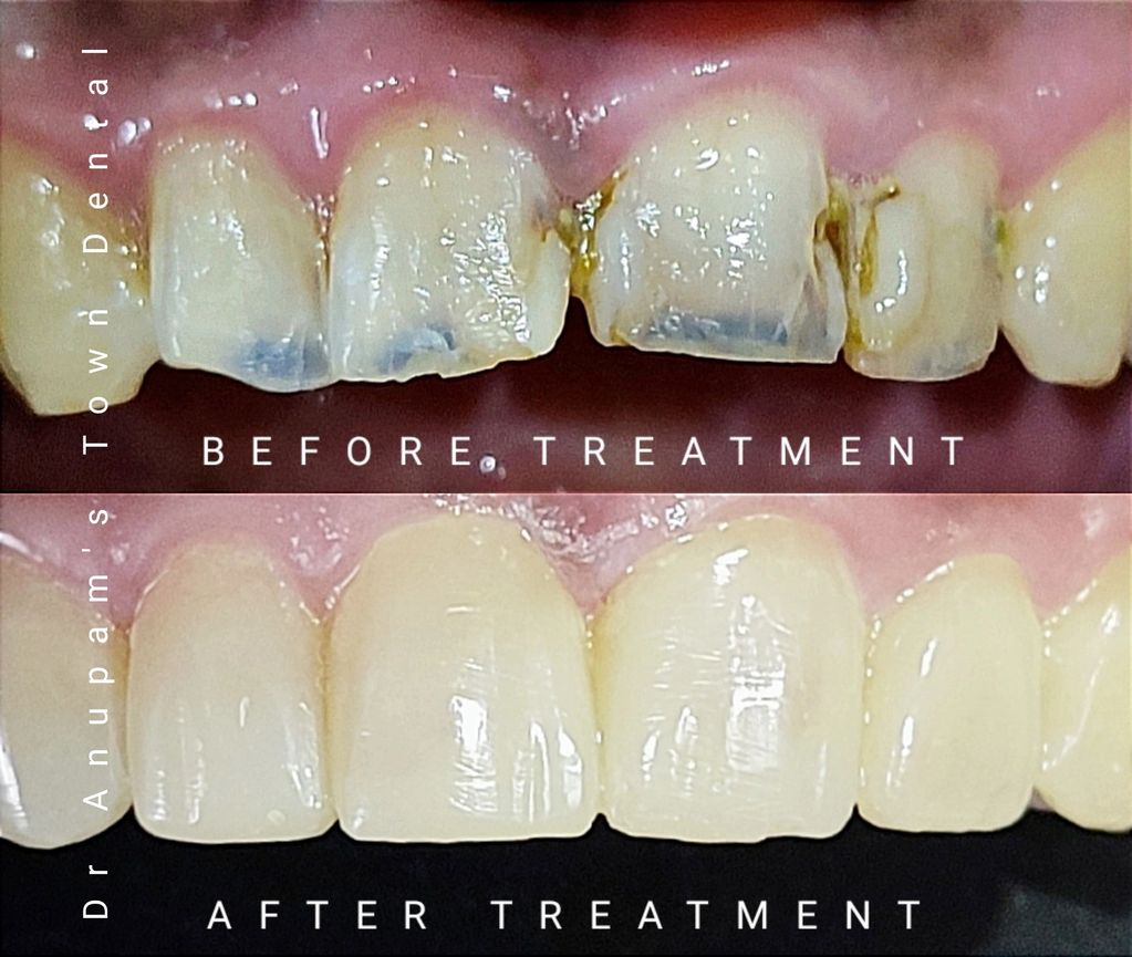 Patient with very unpleasant smile due to dental cavities and staining of teeth of upper teeth. 