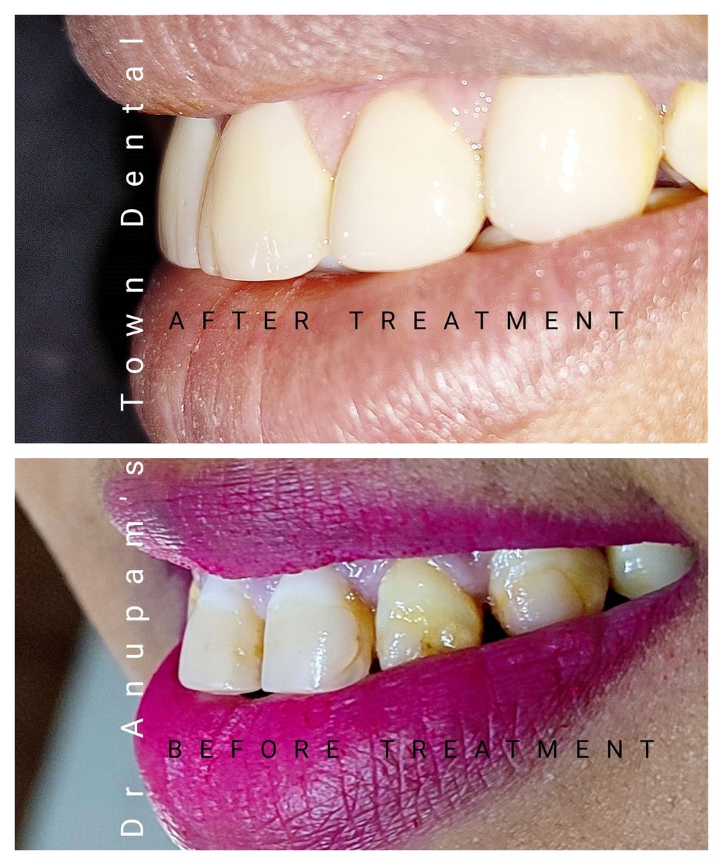 A pleasing smile designing was planned and created by our expert and esthetician Dr Shally . 