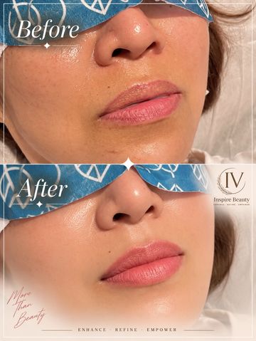 Before and after skin treatment on a woman's face.