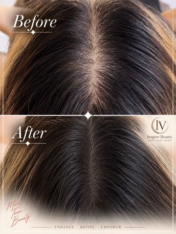 Before and after hair treatment showing reduced scalp visibility.