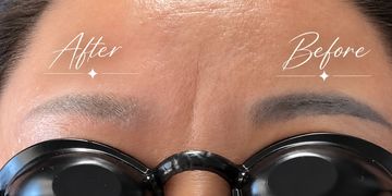 Close-up of forehead before and after treatment.