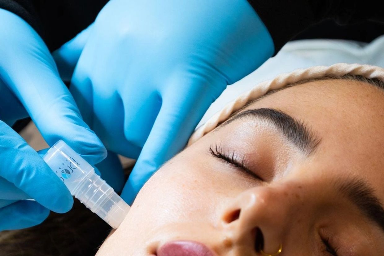 Close-up of a cosmetic procedure on a woman's face.
