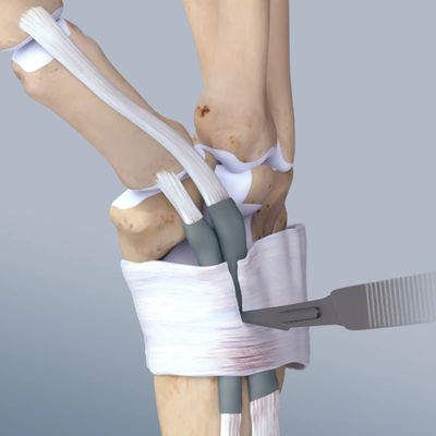 First dorsal compartment release diagram