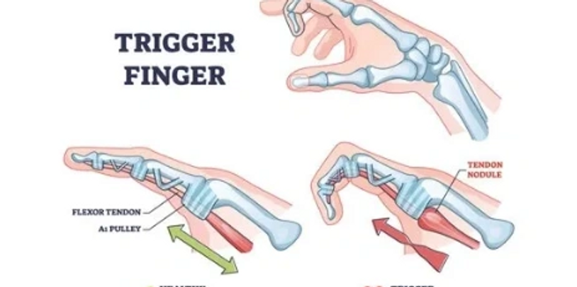 Trigger finger anatomical diagram