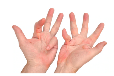 Hands showing evidence of Dupuytrens contracture