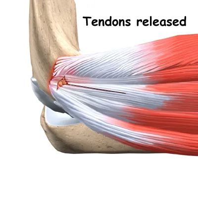 Tennis elbow release diagram