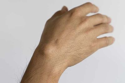 Dorsal wrist ganglion