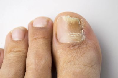 Toe with a damaged toenail.