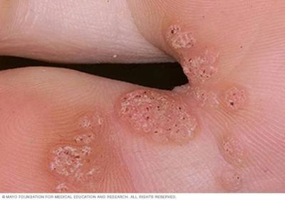 Close-up of a foot with plantar warts.