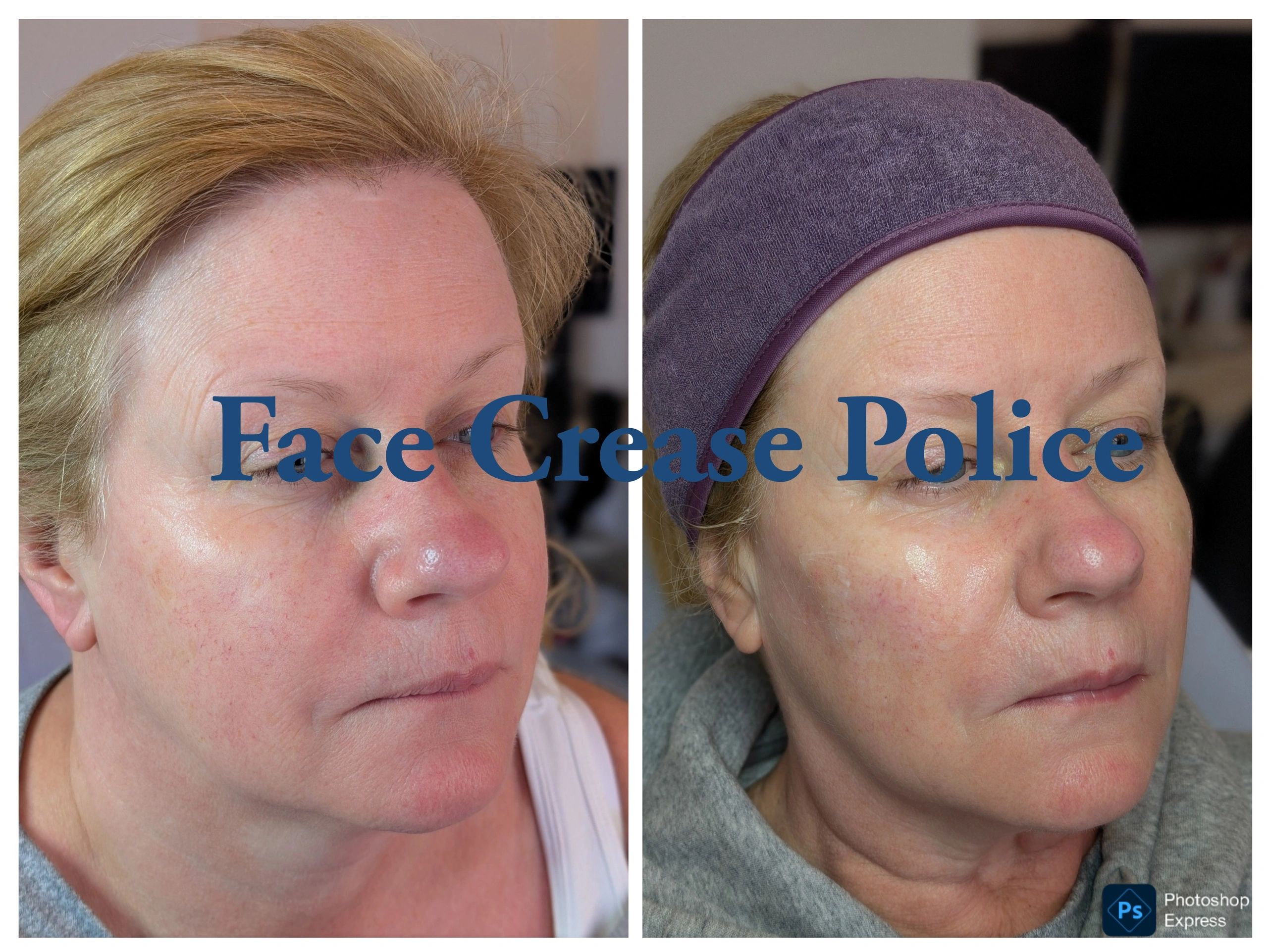 Dermal Filler results