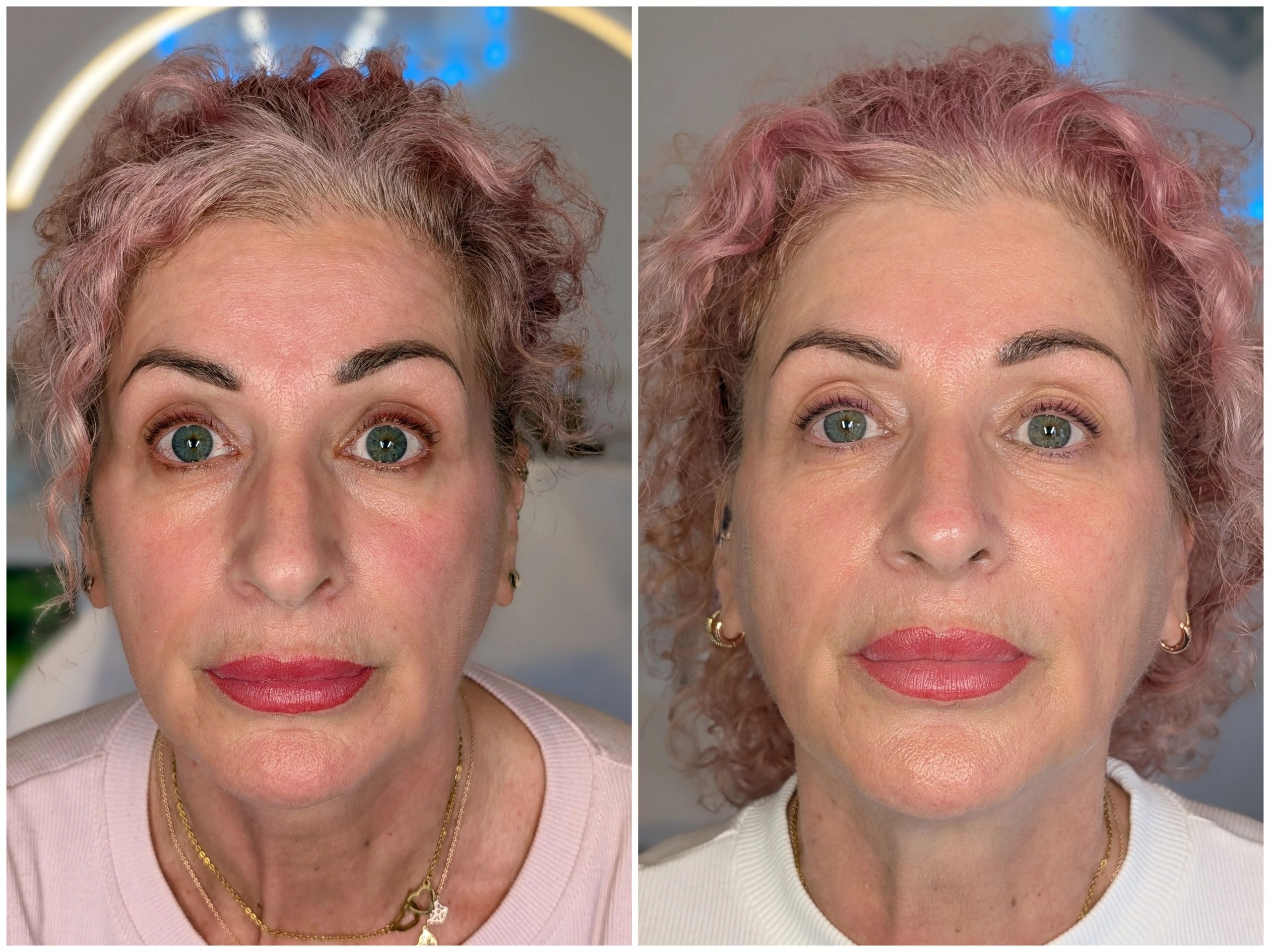 Biostimulation results