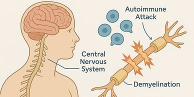 Diagram showing multiple sclerosis affecting the central nervous system.