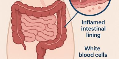 Illustration of inflamed intestinal lining with white blood cells.