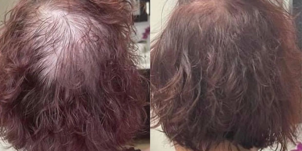 before-and-after-results-of-Procell-microchanneling-hair-treatment-showing-visible-hair-regrowth